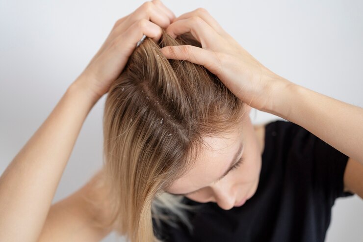dry scalp