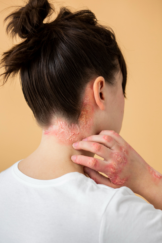 Dry Scalp Relief: Causes, Quick Fixes & Treatments That Work 6 extreme dry scalp