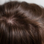 understanding a dry scalp