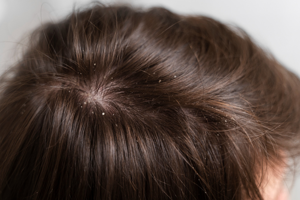 understanding a dry scalp