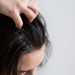 treat oily dandruff
