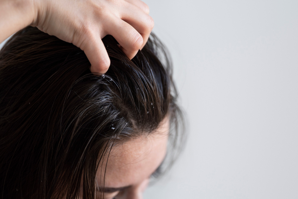 treat oily dandruff